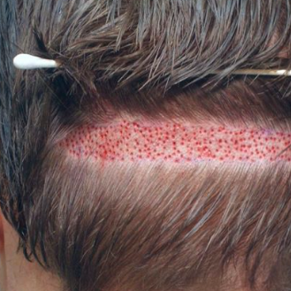 Hair  Transplant
